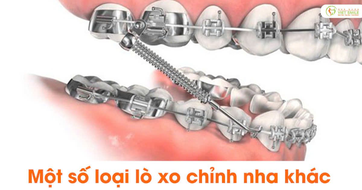 Một số loại lò xo chỉnh nha khác