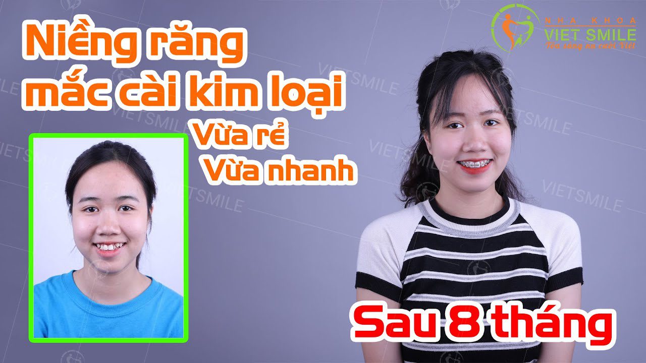 Niềng răng mắc cài