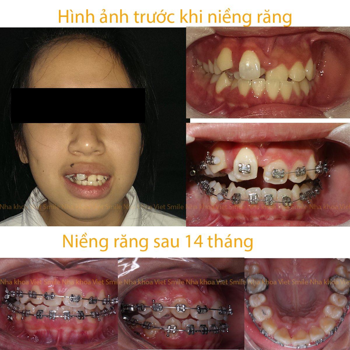 Niềng Răng Hà Nội