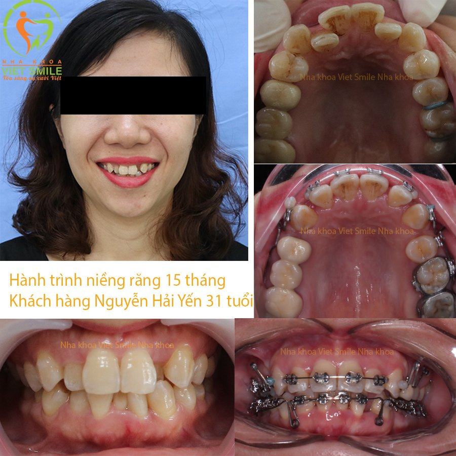 Niềng Răng Hà Nội