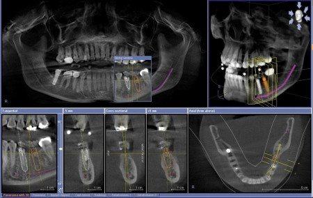 Với sự hỗ trợ khảo sát hình ảnh conebeam 3d, việc cấy ghép implant trở nên dễ dàng hơn