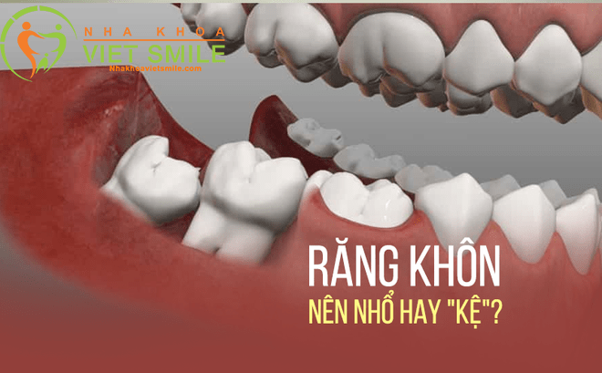 răng khôn những điều cần biết 1 Nho rang khon nha khoa viet smile