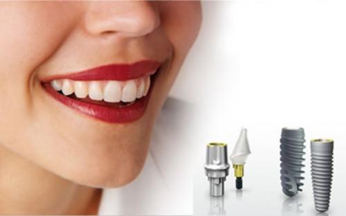 Quy trình cấy ghép implant 6 Tận hưởng nụ cười mới sau khi phục hình trên implant