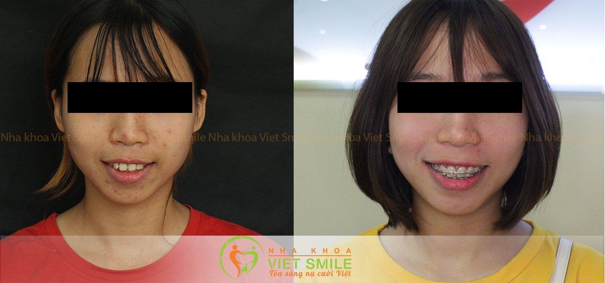 Niềng Răng Hà Nội