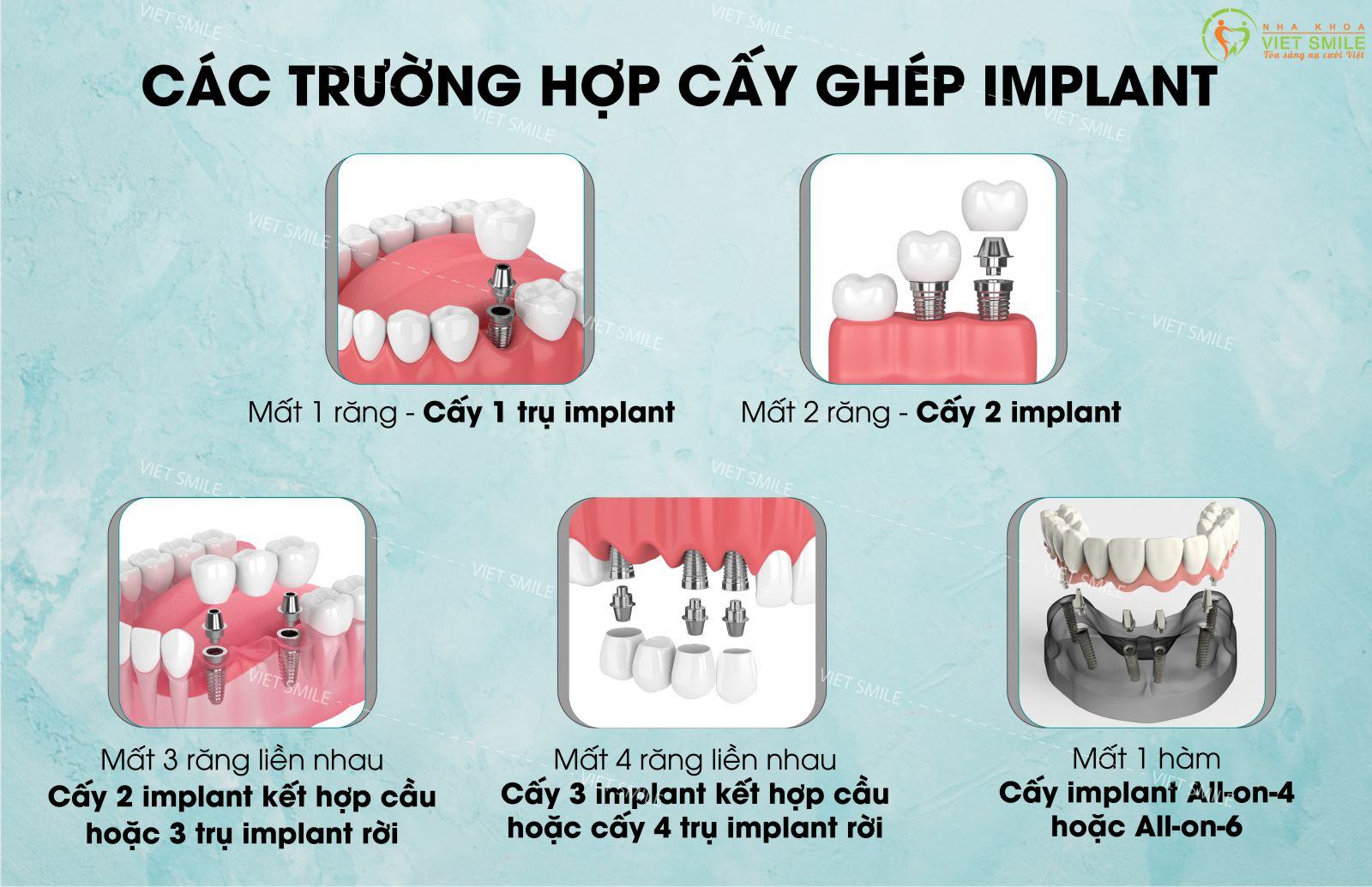 cấy ghép implant 1 Các trường hợp cấy ghép implant