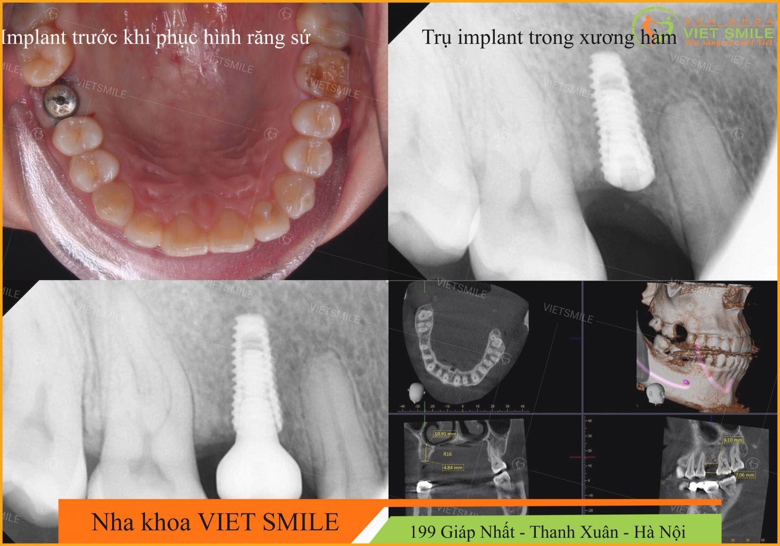 cấy ghép implant 8 Hoàn tất phục hình răng đã mất cho khách hàng