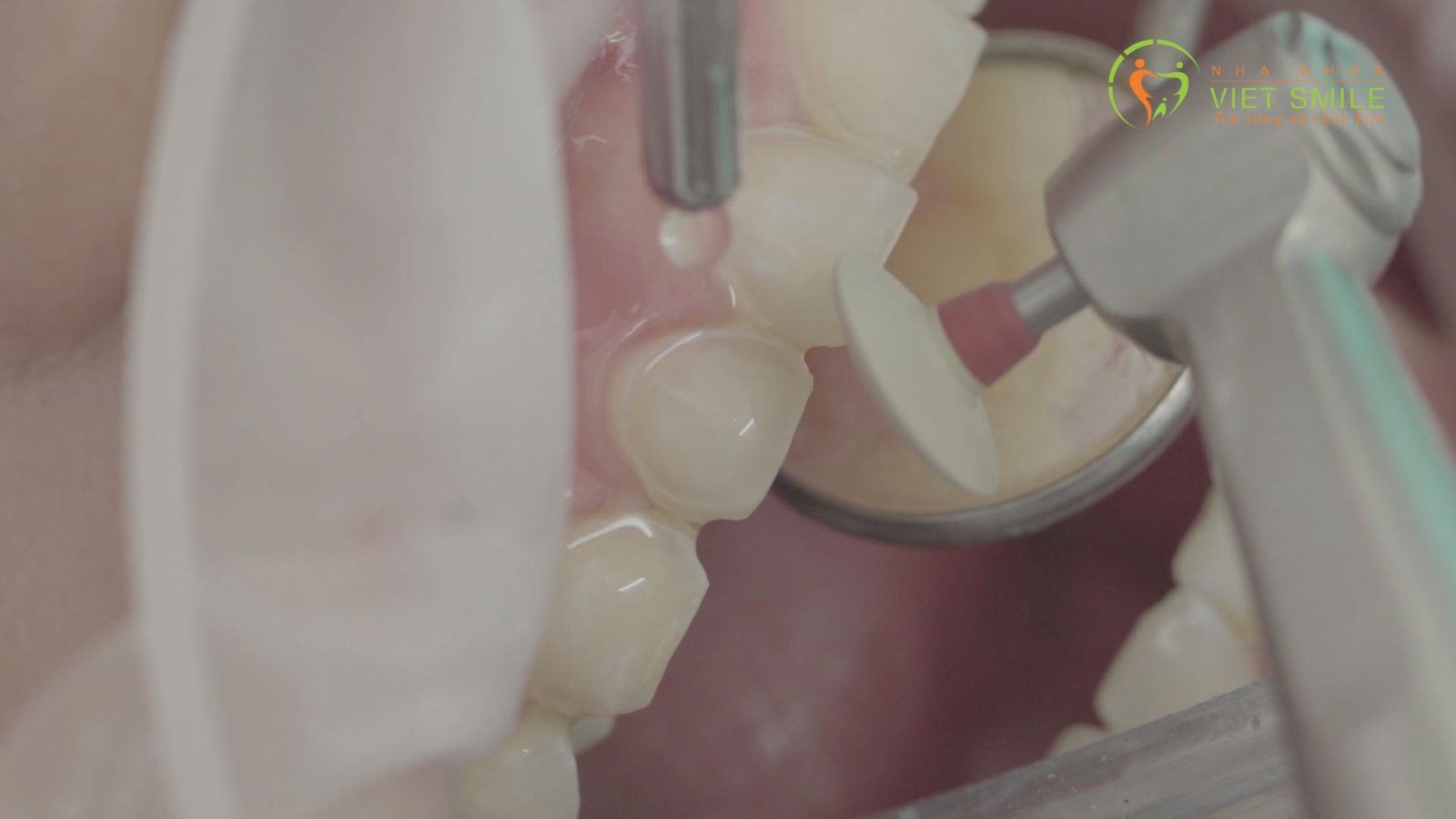 Bác sĩ xử lý làm mịn bề mặt răng và lấy dấu gửi labo để làm miếng dán veneer theo thiết kế form răng dành riêng cho bạn